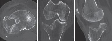 Fig. 7.31, A tibial plateau fracture. Transverse (left) , coronal (middle) , and sagittal (right) multiplanar reformats of the knee demonstrate a comminuted lateral tibial plateau fracture with significant depression of the articular surface.