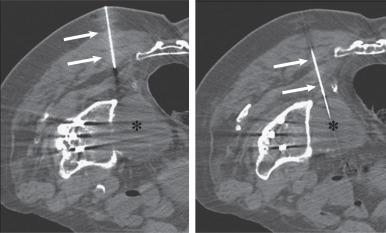 Fig. 7.33, A computed tomography–guided biopsy. Transverse images of the right hip show a large lytic lesion (asterisk) that has eroded through the medial aspect of the right acetabulum and extends into the right hemipelvis. A biopsy needle (arrows) is directed toward the lesion (left) . The needle was advanced into the lesion (right) . Aspiration revealed bloody synovial fluid related to particle disease from the right hip arthroplasty.