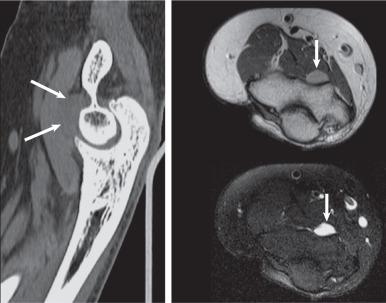 Fig. 7.34, Limited assessment of soft tissue structures with computed tomography (CT). The images are from a 24-year-old woman with a 2-year history of elbow pain. Results of the elbow CT scan, including a sagittal multiplanar reformatted CT image (left) , were reported as normal. In retrospect, a small mass is present anterior to the distal humerus (arrows) that is isodense to muscle. A transverse fast spin-echo proton density image (top right) shows a small, slightly hyperintense mass (arrow) , and a fast spin-echo T2-weighted image with fat saturation (bottom right) readily demonstrates a focal hyperintense soft tissue mass (arrow) . Pathologic findings confirmed that the lesion represented synovial sarcoma.