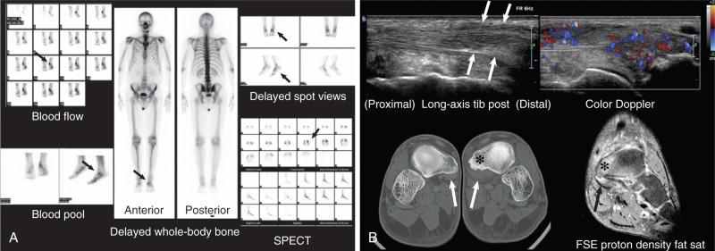 Fig. 7.35, (A) Nonspecific increased activity is shown on a bone scan image in a patient with navicular stress reaction from tibialis posterior tendinopathy. A bone scan was obtained because of clinical suspicion of a left navicular stress fracture. Radiographs (not shown) were reported as normal. Imaging including blood flow, blood pool, and whole body with spot and single photon emission computed tomography (SPECT) views show focal uptake in the region of the left navicular (arrows) . (B) Further investigation with computed tomography (CT), ultrasound, and magnetic resonance imaging (MRI) was carried out. A CT scan (bottom left) obtained for evaluation of a possible stress fracture after the bone scan was conducted shows mild cortical irregularity in the navicular tuberosity (asterisk) from tibialis posterior enthesopathy. The soft tissues show mild asymmetric thickening of the left tibialis posterior tendon (arrows) . A grayscale ultrasound image (top left) shows thickening and decreased echogenicity (arrows) in the distal tibialis posterior tendon (arrows) . A color Doppler image (top right) shows pronounced hyperemia. The ultrasound findings confirmed distal tibialis posterior tendinosis. An MRI image (bottom right) obtained after the ultrasound, CT, and bone scan were conducted shows all the findings in a single examination, including edema in the navicular tuberosity (asterisk) and thickening and increased signal in the distal tibialis posterior tendon (arrow) . MR would have established the diagnosis in the most cost-effective and efficient way if it had been performed as the initial investigation in this patient. fat sat, Fat saturated; FSE, fast spin-echo.