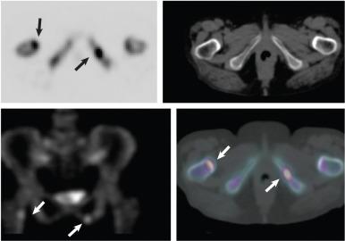 Fig. 7.36, Single photon emission computed tomography/computed tomography (SPECT/CT) images (from a 4-detector CT unit) of left ischiopubic ramus and right femoral neck fractures. A 70-year-old woman had atraumatic severe bilateral hip pain and negative radiographs (not shown). The planar anteroposterior spot view (inverted image) from a total body bone scan (bottom left) shows focal areas of uptake in the right medial femoral neck and left inferior ischiopubic ramus (arrows) . A transverse SPECT image (top left) shows focal uptake of radiotracer in the same regions (arrows) . A low-dose CT image from a 4-detector CT scan (top right) shows no obvious abnormality in the regions. The quality of the low-dose 4-slice scan is suboptimal compared with the image quality from a standard-dose 16- to 64-detector unit. A hybrid SPECT/CT image (bottom right) confirms the precise site of increased radiotracer uptake on the CT scan (arrows) .