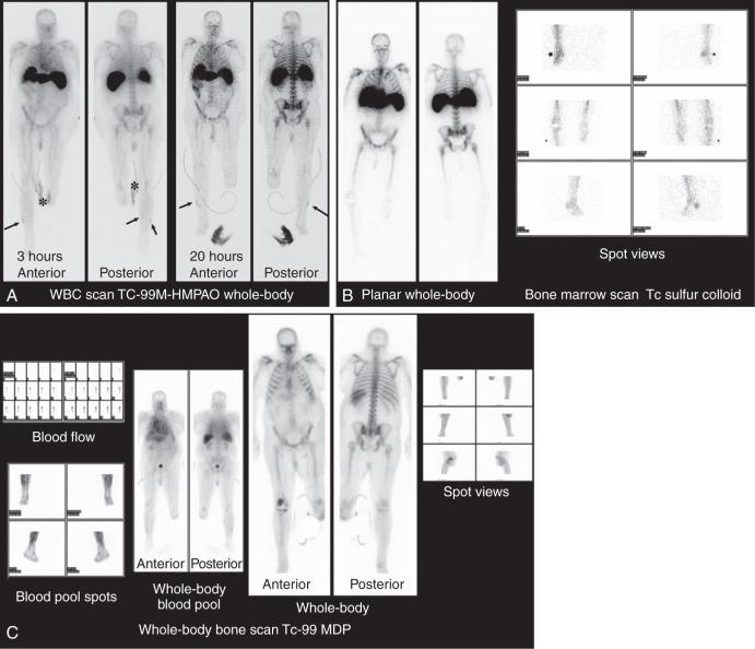 Fig. 7.37, (A) A labeled white blood cell scan to check for osteomyelitis in a 69-year-old patient with brittle diabetes who had cutaneous ulcers in the right lower extremity. The patient had a history of left below-knee amputation and failed right knee arthroplasty. A technetium-99m hexamethylpropylene amine oxine (Tc-99m-HMPAO) labeled whole-body white blood cell (WBC) scan shows two small superficial areas of faint uptake corresponding to the site of the ulcers on both the 3-hour (left) and 20-hour (right) scans (arrows) . No focal increased uptake of tracer is evident in the bone marrow to suggest osteomyelitis. Normal uptake of tracer is evident in the liver and spleen. A small amount of uptake is evident in the medial aspect of the left knee on the 3-hour scan corresponding to contamination from the urine (asterisk) . (B) A technetium (Tc) sulfur colloid bone marrow scan to check for osteomyelitis. The sulfur colloid study was performed in conjunction with the labeled WBC scan in the same patient as in A. The bone marrow scan shows a similar concordant distribution in both the whole-body (left) and spot views (right) compared with the WBC scan. The absence of increased WBC uptake relative to the bone marrow scan makes the diagnosis of osteomyelitis unlikely. The soft tissue uptake on the WBC scan most likely reflects cellulitis rather than osteomyelitis. Sulfur colloid scans may be required as part of a labeled WBC scan to provide a map of the normal regional variations in the distribution of bone marrow. (C) A bone scan to check for osteomyelitis. A technetium-99 methylene diphosphonate (MDP) skeletal scintigram in the same patient as in A and B was performed as part of a WBC scan for possible osteomyelitis in the left leg. Blood flow, blood pool, and delayed whole-body images show no increased activity in the right lower extremity, ruling out the diagnosis of osteomyelitis. Increased activity present in the right knee is related to patellofemoral osteoarthritis and recent removal of an arthroplasty prosthesis.