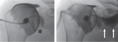 Fig. 7.4, A distension arthrogram for adhesive capsulitis. The initial fluoroscopic spot view (left) in a shoulder arthrogram for adhesive capsulitis shows restricted filling of the axillary (asterisk) and subscapularis recesses and early rupture of the capsule medially, which is consistent with the diagnosis. Further injection of contrast material (right) shows additional extraarticular extravasation into the soft tissues medially (arrows) .