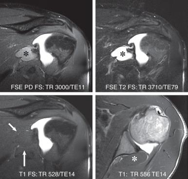 Fig. 7.5, A magnetic resonance (MR) arthrogram. Dilute gadolinium (1/200) is injected into the glenohumeral joint followed by MR imaging. The small amount of gadolinium is sufficient to create high T1 signal intensity in the joint fluid on both T1 with fat saturation (T1FS; bottom left) and T1 without fat saturation images (T1; bottom right) . The joint fluid is also bright on the proton density (FSE PD FS) and T2-weighted (FSE T2 FS) sequences ( top left and top right images, respectively). A large paralabral cyst is present medial to the glenoid ( arrows and asterisk ). The cyst fluid is isointense to muscle on both the T1-weighted images with and without fat saturation and is easily missed. T2-weighted images are required to visualize extraarticular pathology in MR arthrography.