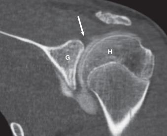 Fig. 7.6, A computed tomography (CT) shoulder arthrogram for a 16-year-old patient with clinical concern regarding a superior labral anterior to posterior (SLAP) tear. This study was originally arranged as a magnetic resonance (MR) arthrogram in which approximately 12.0 mL of 0.1 cc gadolinium diluted in 20 mL Isovue 300 was instilled into the joint. The patient was claustrophobic and unable to complete the MR arthrogram. A CT scan was immediately arranged to image the shoulder prior to systemic resorption of the contrast media. The small amount gadolinium in the joint fluid does not degrade the quality of the CT image. The superior labrum (arrow) is intact, without evidence of a SLAP tear or other abnormality. G, Glenoid; H, humeral head.