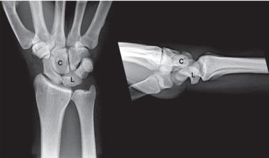 Fig. 7.7, A midcarpal dislocation shows the necessity for two orthogonal radiographic projections. The posteroanterior view of the wrist (left) shows subtle abnormalities consisting of a minor disruption of the proximal and midcarpal alignment and a triangular-shaped lunate (L) . The lateral view (right) confirms malalignment of the midcarpal joint with the capitate (C) situated dorsal to the lunate (L) .