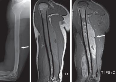 Fig. 7.8, False-negative radiographs in a patient with lymphoma of bone. A lateral radiograph of the humerus (left) shows a subtle small area of osteolysis in the mid diaphysis of the humerus (arrow) . A sagittal spin-echo T1-weighted image (T1; middle) shows replacement of virtually all of the visualized marrow cavity by tumor with intermediate signal intensity. A spin-echo T1-weighted image with fat saturation (T1FS + C; right) shows heterogeneous enhancement of the tumor both within the marrow and also in the posterior (arrow) and anterior soft tissues after administration of gadolinium contrast material.