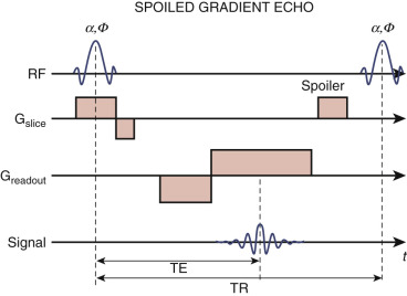 FIG 4-2, The spoiled gradient echo sequence is the method of choice for CE MRA data acquisition. The transverse magnetization is forced into a steady state by a combination of gradient dephasing, also called spoiling, which is usually played as a strong gradient lobe along the slice-select and/or readout directions, and phase spoiling by adding a pseudorandom phase ϕ to the RF excitation.