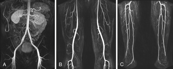 FIG 4-4, CE MRA of the pelvis ( A ), thighs ( B ), and calves ( C ) in a single patient. The three stations are displayed as coronal maximum intensity projection (MIP) images and capture the bolus with high quality and high arterial signal. Some venous and renal parenchymal enhancement can be observed in the pelvic station, where the contrast agent is quickly passing through the arterial bed ( A ).