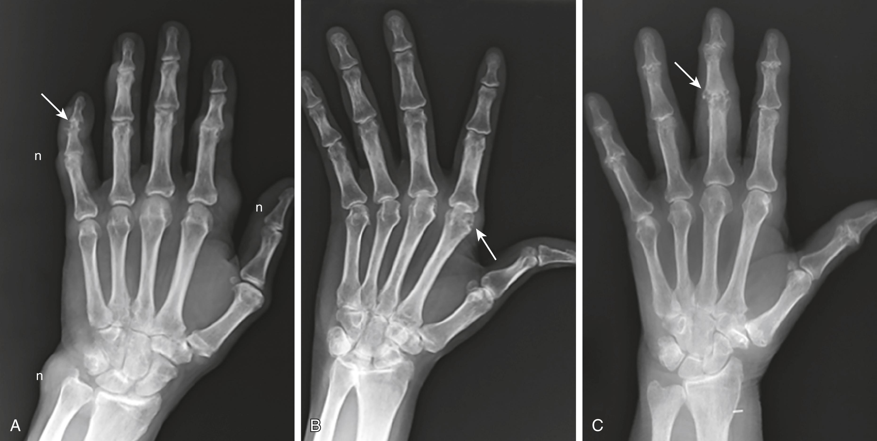 FIGURE 238-1, Three hands with different diagnoses.