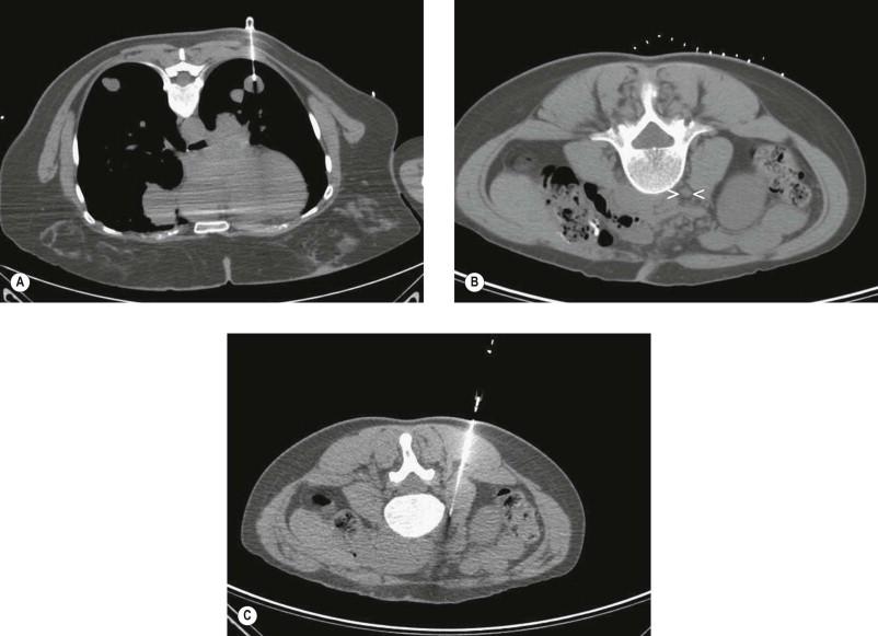 Figure 21-1, CT-guided FNAB. (A) CT-guided percutaneous FNAB of pulmonary nodule. Cytology revealed metastatic leiomyosarcoma. (B) Abdominal CT showing a 1 cm retroperitoneal lymph node (> <) in a patient with colon cancer. (C) CT-guided biopsy of the retroperitoneal node shown in (B). The aspirate revealed metastatic adenocarcinoma consistent with a colon primary.