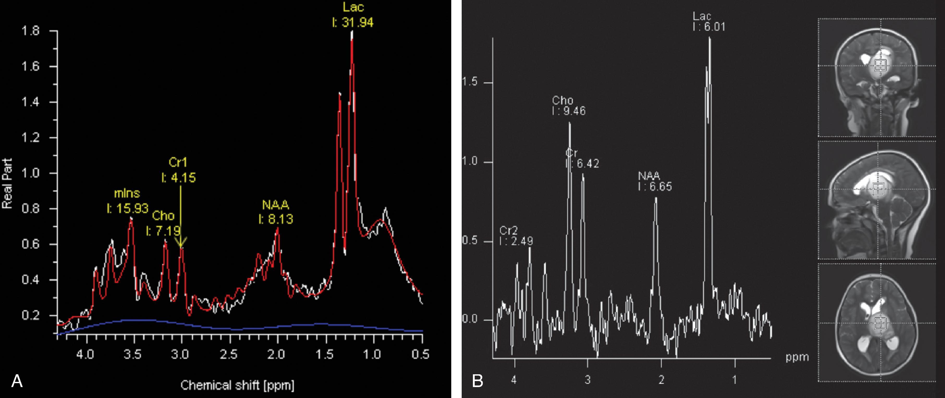 Fig. 22.6, Clinical Uses of H1 MR Spectroscopy.