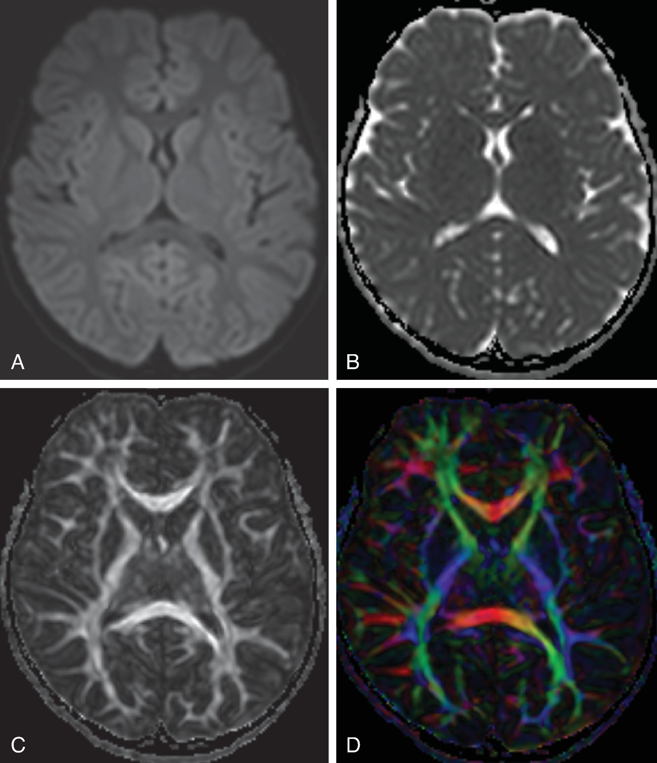 Fig. 22.7, Diffusion Tensor Imaging.