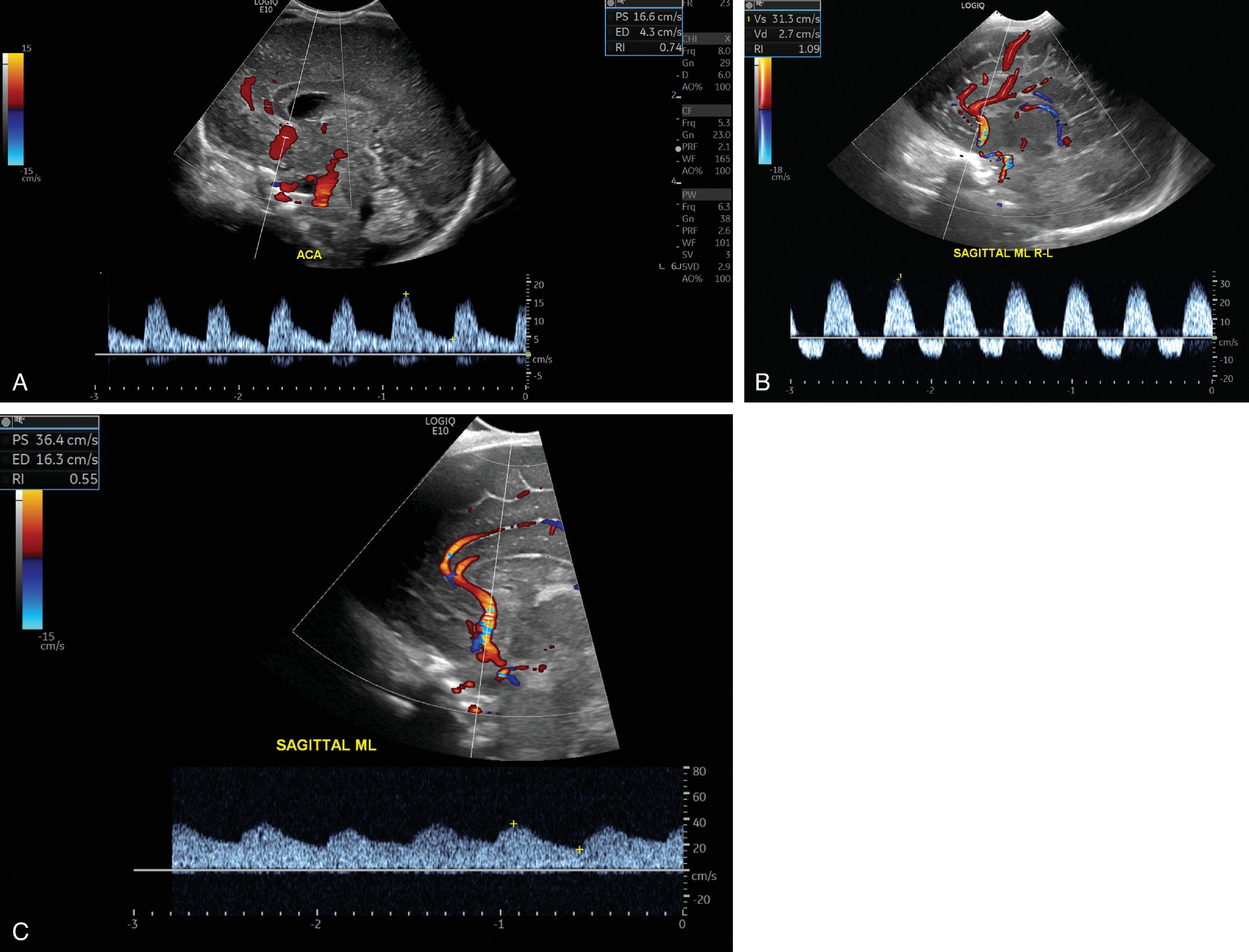 Fig. 22.1, Spectral Doppler With RI (Resistive Index) on the Anterior Cerebral Artery in Cases of Suspected Hypoxic Ischemic Injury, Ventriculomegaly, and Infection.