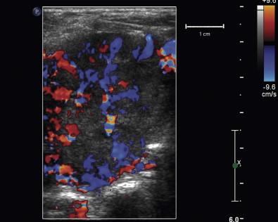 Figure 21-2, Color Doppler US. Color Doppler US of a large hypervascular left thyroid nodule. FNAB revealed changes suspicious for follicular neoplasm. Doppler US permits real-time evaluation of lesion vascularity and aids in identification and avoidance of large vessels at the biopsy site