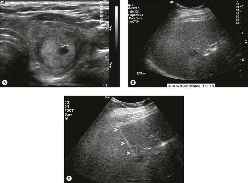 Figure 21-3, US-guided FNA. (A) Transverse US image of the left thyroid lobe reveals a predominately solid nodule. The tip of the 25-G biopsy needle (>) is seen within the nodule. Cytology revealed a Hürthle cell nodule in a background of chronic lymphocytic thyroiditis. (B) Subcostal transverse US image of the right lobe of the liver shows a 1.2 cm hypoechoic mass suspicious for metastatic disease in a patient with a pancreatic mass. The projected needle path for biopsy is indicated by the dotted line through the lesion. (C) FNAB of liver nodule with a 22-G Chiba needle. The needle is seen (>) with its tip within the lesion. Cytology confirmed metastatic adenocarcinoma, likely of pancreatic origin.