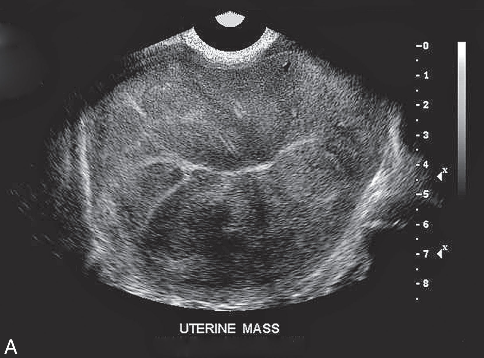 Fig. 7.2, (A) The typically grainy appearance of this ultrasound image is not primarily the result of detail resolution limitations but rather of speckle. Speckle is the interference pattern resulting from constructive and destructive interference of echoes returning simultaneously from many scatterers within the propagating ultrasound pulse at any instant. (B) Approaches to speckle reduction ( right image compared with the left ) are implemented in modern instruments.