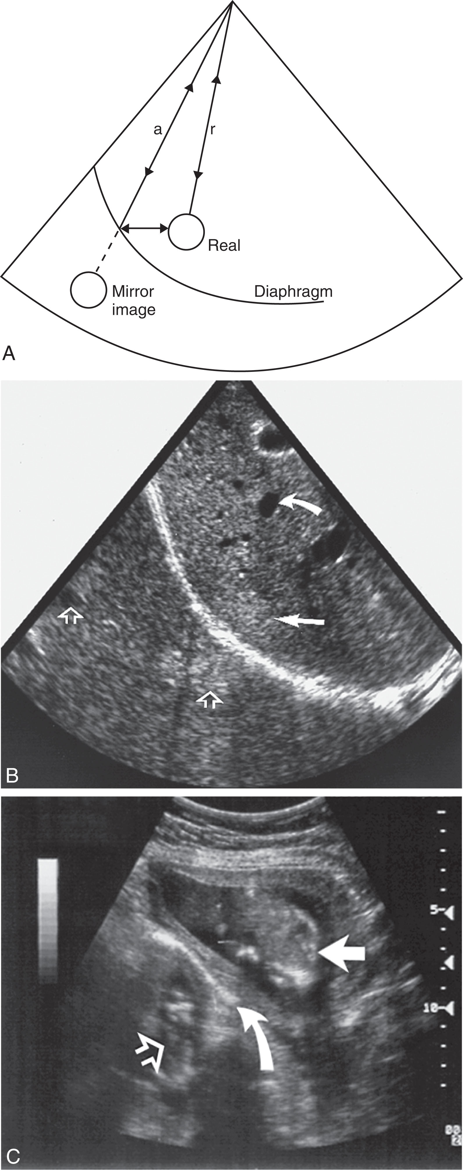 Fig. 7.7, (A) When pulses encounter a real hepatic structure directly (scan line r ), the structure is imaged correctly. If the pulse first reflects off the diaphragm (scan line a ) and the echo returns along the same path, the structure is displayed on the other side of the diaphragm. (B) A hemangioma (straight arrow) and vessel (curved arrow) with their mirror images (open arrows) . (C) A fetus (straight arrow) also appears as a mirror image (open arrow) . The mirror (curved arrow) is probably echogenic muscle.