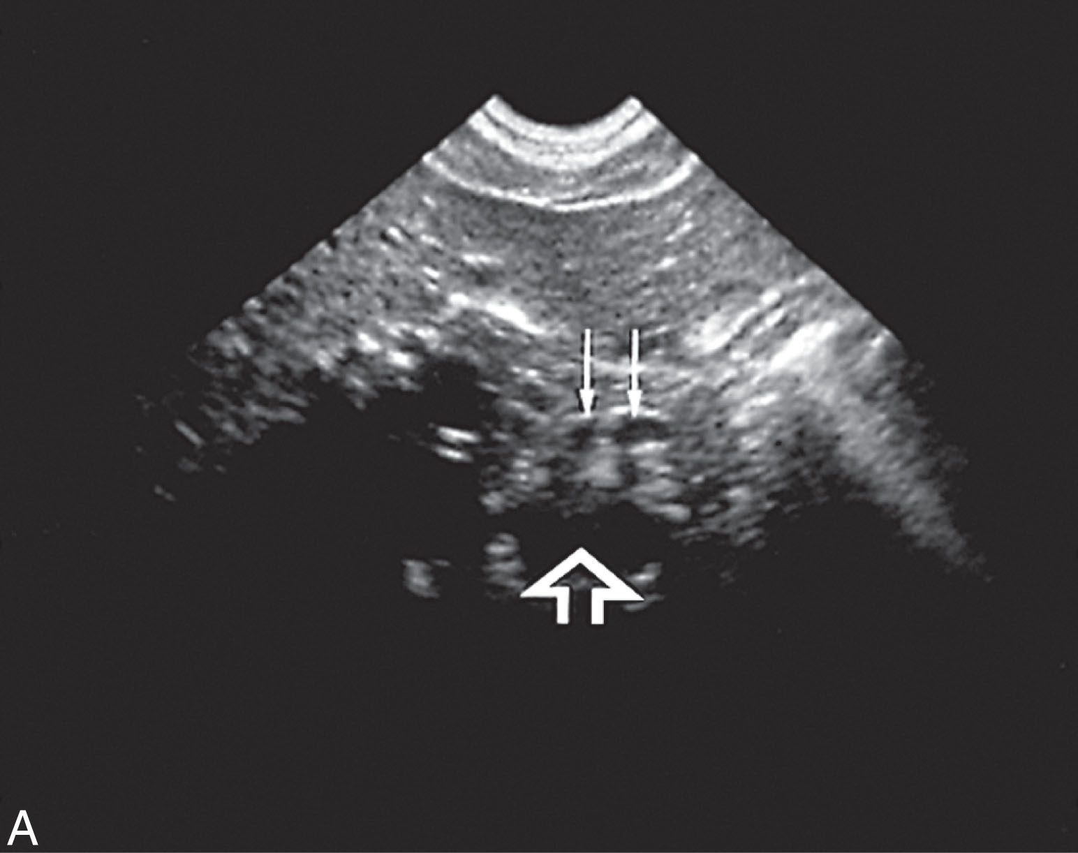 Fig. 7.10, (A) Refraction (probably through the rectus abdominis muscle) has widened the aorta (open arrow) and produced a double image of the celiac trunk (arrows) . Refraction may cause a single gestation (B) to appear as a double gestation (C).