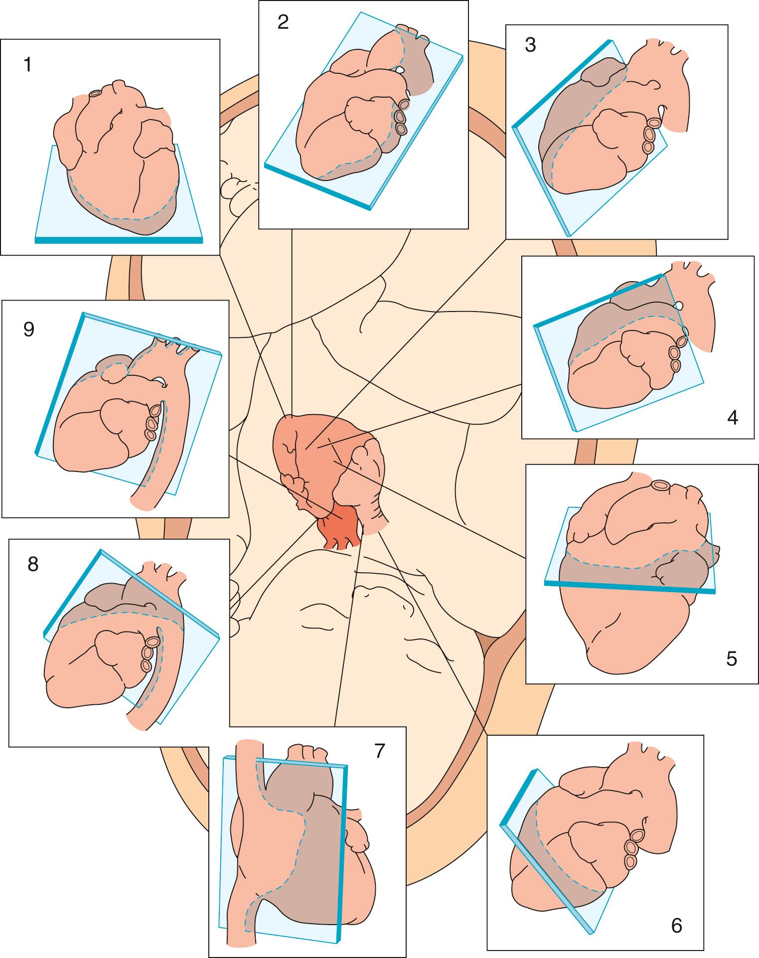 Fig. 8.1, Tomographic planes used to image the fetal cardiovascular system. Imaging planes displayed are in a normal human fetus. Starting at the top left, the following views are demonstrated in a clockwise manner: 1 , apical (four-chamber) view; 2 , apical (five-chamber) view angled toward the aorta; 3 , long-axis view of the left ventricular outflow tract; 4 , long-axis view of the right ventricular outflow tract; 5 , short-axis view at the level of the great vessels; 6 , short-axis view with caudad angling at the level of the ventricles; 7 , caval long-axis view; 8 , ductal arch view; 9 , aortic arch view.
