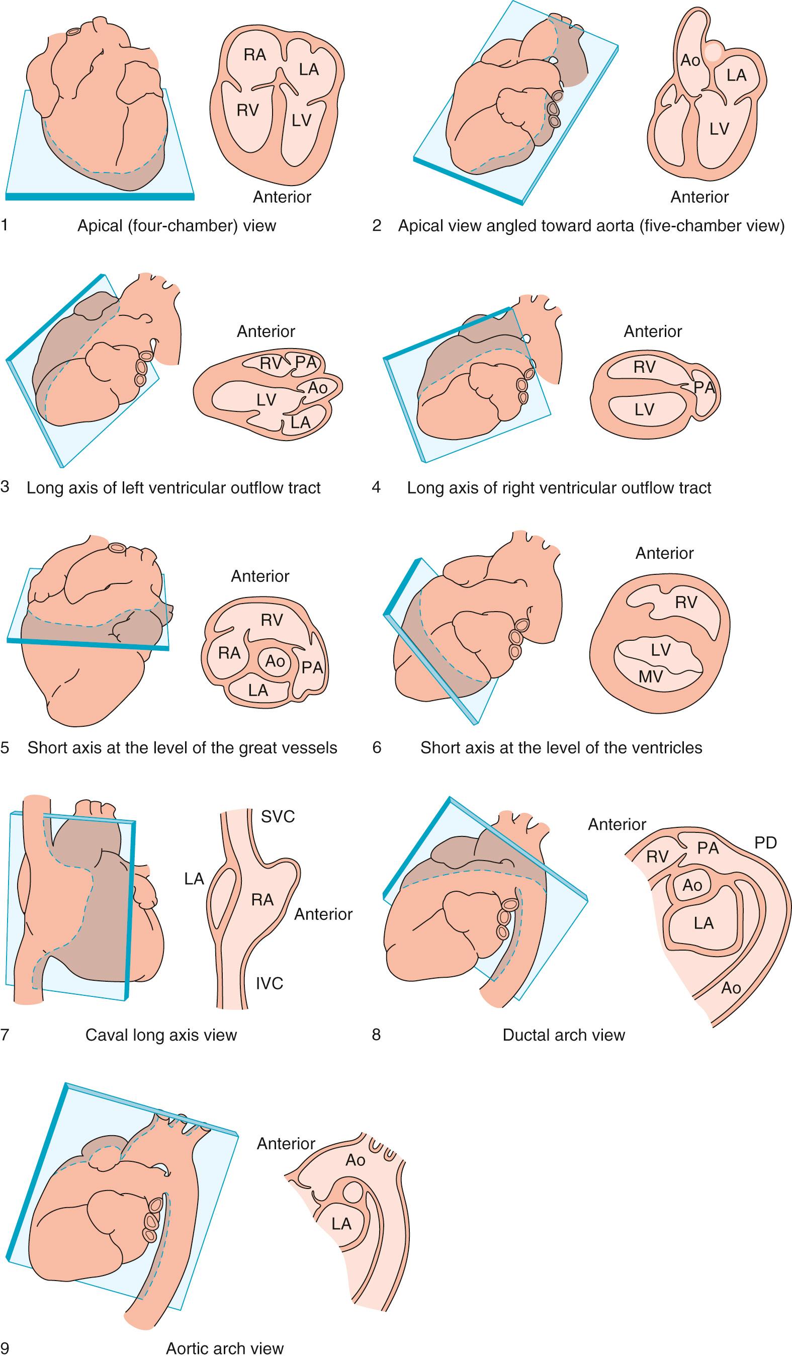 Fig. 8.2, Anatomic correlates for each of the designated tomographic imaging planes used for imaging of the fetal cardiovascular system. Each numbered view relates to the clockwise illustration of the fetal heart in Fig. 8.1 . Ao , Aorta; IVC , inferior vena cava; LA , left atrium; LV , left ventricle; MV , mitral valve; PA , pulmonary artery; PD , patent ductus; RA , right atrium; RV , right ventricle; SVC , superior vena cava.