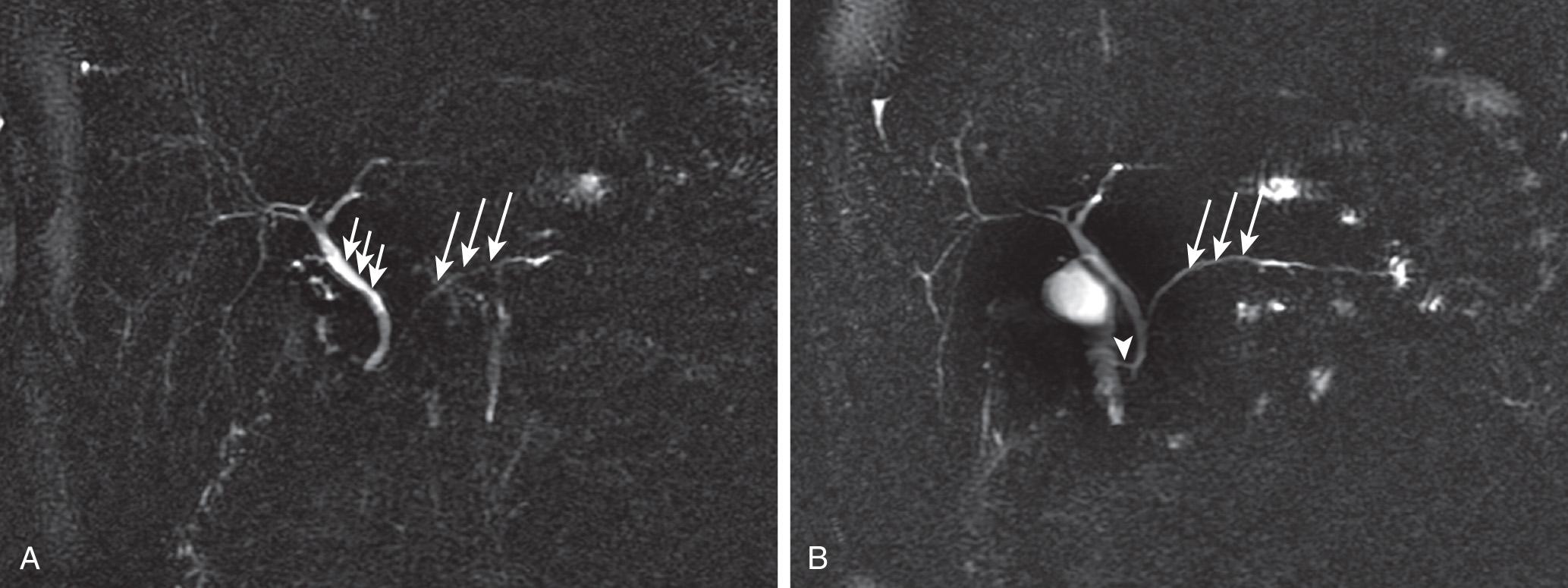 FIGURE 95.1, Pancreas divisum. (A) Thick-slab magnetic resonance cholangiopancreatography image before secretin administration demonstrates the pancreatic duct (long arrows) . Short arrows indicate the common bile duct. (B) Following secretin administration, the pancreatic duct (long arrows) becomes much better defined as a result of distention and its separate opening to the duodenum (arrowhead) via the minor papilla and becomes more prominent.