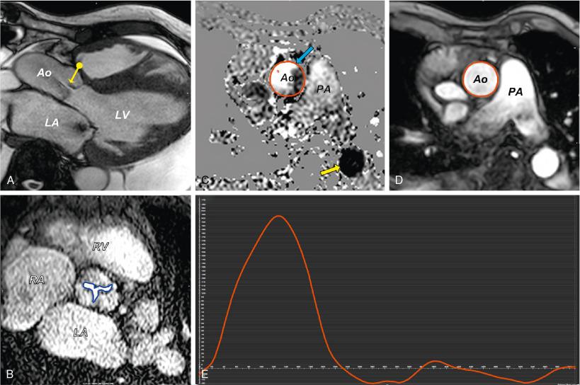 Fig. 13.11, Cardiovascular Magnetic Resonance Imaging Techniques for Evaluation of Aortic Valve Disease.