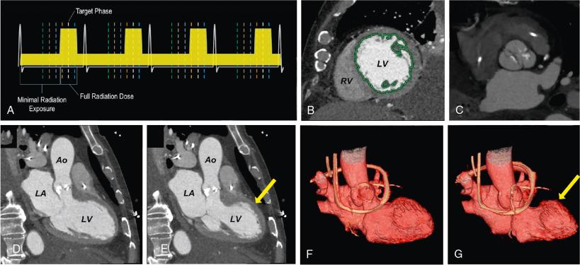 Fig. 13.4, Utility of ECG-Gated Computed Tomography (CT) Angiography for Structural Heart Disease.