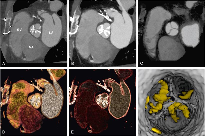 Fig. 13.5, Different Aortic Valve Visualizations With Computed Tomography (CT).