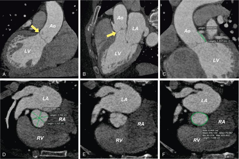 Fig. 13.7, Measurements of the Aortoannular Complex With Gated Computed Tomography (CT).