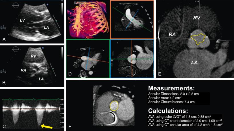 Fig. 13.8, Gated Computed Tomography (CT) in Low-Flow, Low-Gradient Aortic Stenosis.