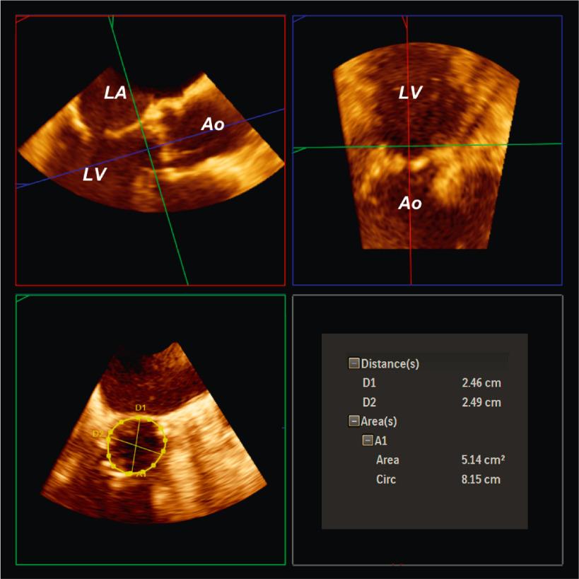 Fig. 13.9, Measurement of Aortic Annulus on 3D TEE.