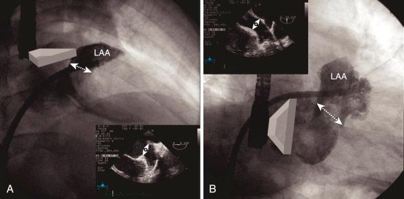 Fig. 48.1, (A) Shows right anterior oblique (RAO) cranial view of left atrial appendage (LAA) injection. The “width” of the LAA opening is shown (dotted arrows) , which is also depicted by horizontal view in transesophageal echocardiography (TEE) (inset) . (B) Shows RAO caudal view of the LAA in the same subject, showing the “height” of the opening (dotted arrows) , which corresponds to a vertical view by TEE (inset) .