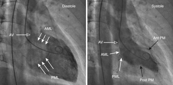 Fig. 48.2, Right anterior oblique 30-degree view of the left ventricle in diastole and systole. The aortic valve (open arrow) , mitral valve (solid white arrows) , and the papillary muscles (solid black arrows) are shown. In diastole, mitral valve is open and there is clearance of contrast as the blood enters the left ventricle from left atrium. Anterior and posterior leaflets are seen separate in diastole (left panel) . In systole, the mitral valve is closed and the aortic valve is open (right panel) . In this view, anterior, apex, and the inferior walls can be assessed. AML , Anterior mitral leaflet; Ant PM , anterolateral papillary muscle; AV , aortic valve; PML , posterior mitral leaflet; Post PM , posterolateral papillary muscle.