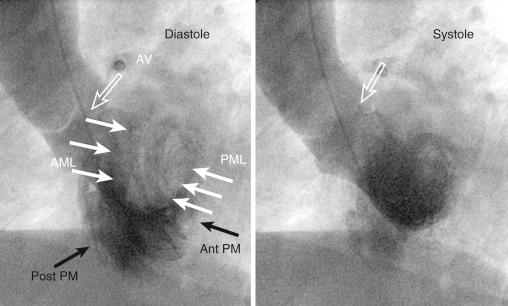 Fig. 48.3, Left anterior oblique 60-degree view of the left ventricle in diastole and systole. The aortic valve (open arrow) , mitral valve (solid white arrows) , and the papillary muscles (solid black arrows) are shown. In diastole, the mitral valve is open and there is clearance of contrast as the blood without contrast enters the left ventricle from left atrium. Anterior and posterior leaflets are seen separate in diastole (left panel) . In this view, lateral and the septal walls can be assessed. AML , Anterior mitral leaflet; Ant PM , anterolateral papillary muscle; AV , aortic valve; PML , posterior mitral leaflet; Post PM , posterolateral papillary muscle.