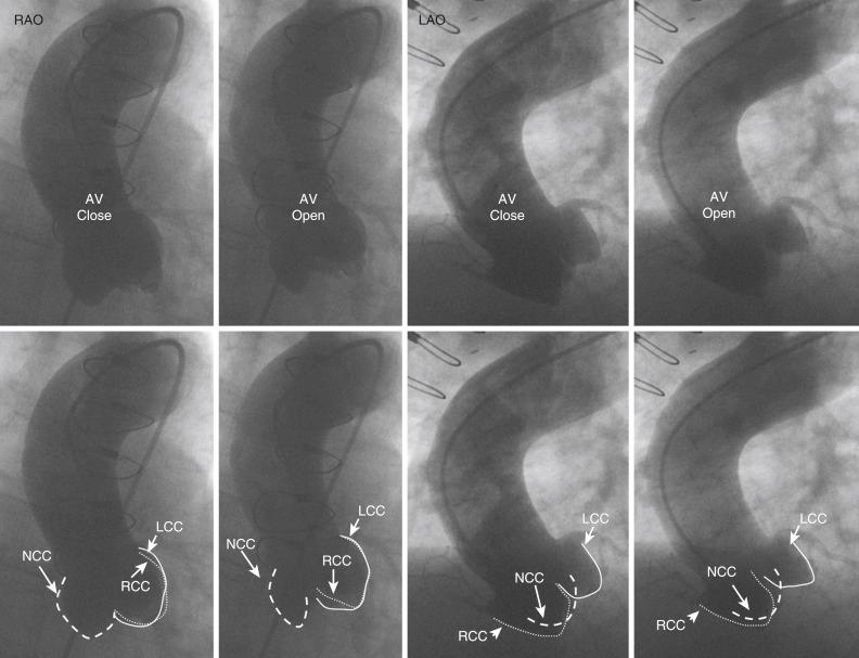 Fig. 48.4, Shallow right anterior oblique (RAO) and left anterior oblique (LAO) aortograms in a subject with aortic stenosis and restricted leaflet motion are shown. Different structures are delineated by dashed lines and arrows in the bottom panel. For each view, the aortic valve in the closed and open position is shown. Note the overlap of the left and right coronary cusps in the RAO projection and the right and noncoronary cusps in the LAO projection. AV , Aortic valve; LCC , left coronary cusp; NCC , noncoronary cusp; RCC , right coronary cusp.