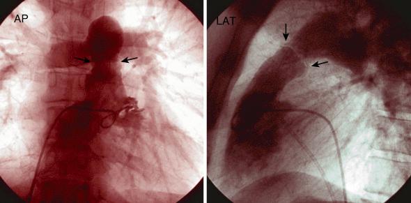 Fig. 48.6, Anteroposterior (AP) and lateral (LAT) view of the right ventricle with the pigtail catheter in the right ventricular outflow tract is shown. Note doming of the pulmonic valve as shown by the black arrows .