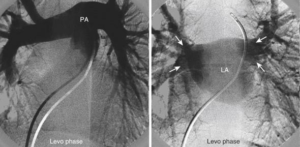 Fig. 48.7, Normal pulmonary angiogram is shown in the anteroposterior view. Large volume of dye (40 mL/s) is rapidly injected using a National Institute of Health catheter. Left panel shows the pulmonary artery trunk and the left and right pulmonary arteries and their branches. Right panel shows opacification of the left atrium in the levo phase. Digital subtraction is used to visualize the pulmonary veins (solid white arrows) . LA , Left atrium; PA , pulmonary artery.