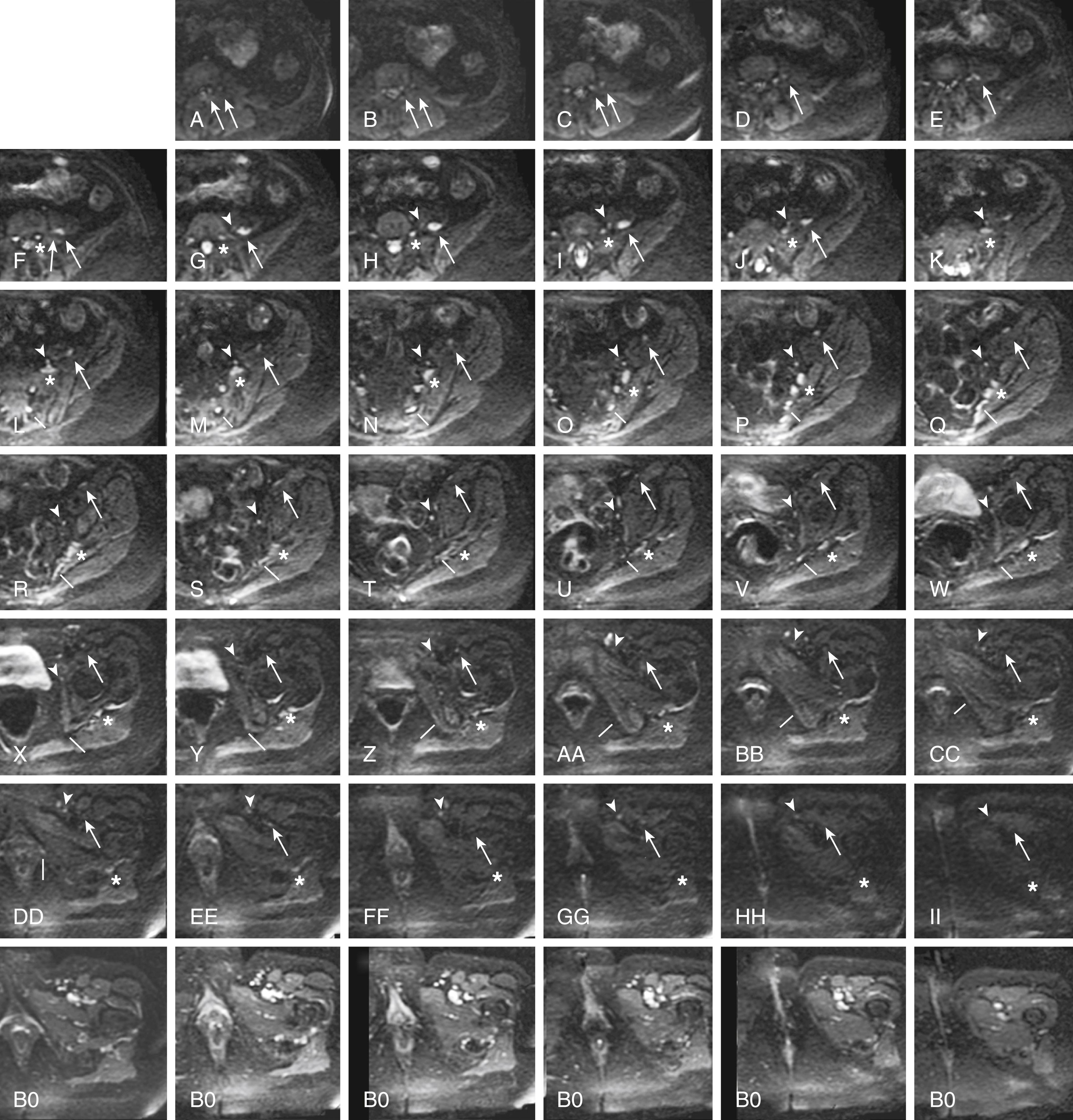 FIGURE 183.1, Use of diffusion tensor image (DTI) data for nerve identification. This series of images demonstrates the use of diffusion-weighted components of a DTI acquisition (A to II) for nerve identification in the same patient as in Fig. 183.4 . The asterisks track the L5 spinal nerve as it progresses through to the sciatic nerve (F to II). The arrows track the L3 spinal nerve (left arrow) and L4 spinal nerve (right arrow) as they progress into the femoral nerve (A to F) and then mark the femoral nerve (F to II). The arrowheads (G to II) show the progress of the obturator nerve as it forms from anterior L4 and L5 branches, and then descends through the obturator foramen. The lines track the S2 contribution to the pudendal nerve (L to DD). Appropriately selected DTI component images contain relatively pure nerve images with very significant suppression of vessels and other structures that are bright on T2-weighted images. Note that the matched B0 (nondiffusion) component of the DTI acquisition obtained a few seconds earlier in the same patient shows numerous bright structures at the inguinal ligament that make identification of the femoral nerve and obturator nerve impossible without reference to the diffusion image.