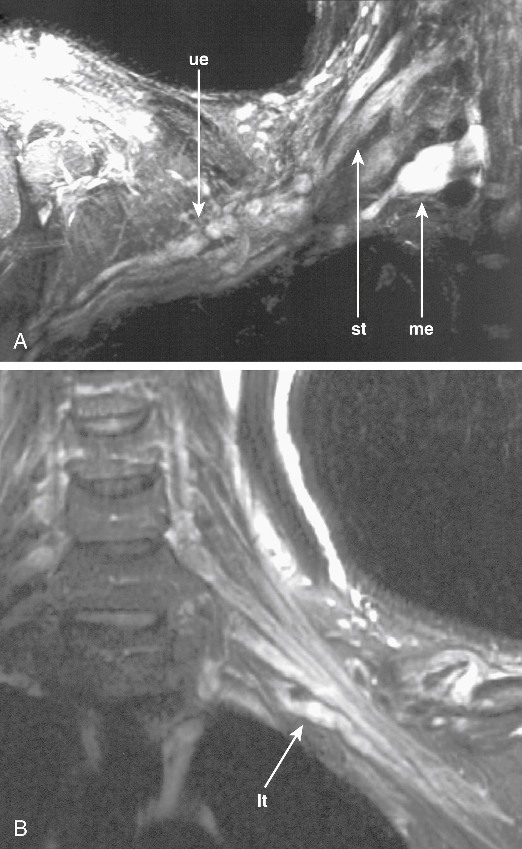 FIGURE 183.3, Confirmation of total nerve disruption in trauma. (A) The right brachial plexus of a 15-year-old with flail arm, 2 months after a motorcycle accident. The image demonstrates gross discontinuities in the upper plexus elements (ue) , meningoceles proximally (me) , and bright swollen nerve trunks (st) . (B) Disconnected and retracted lower trunk (lt) in traumatic injury of brachial plexus.