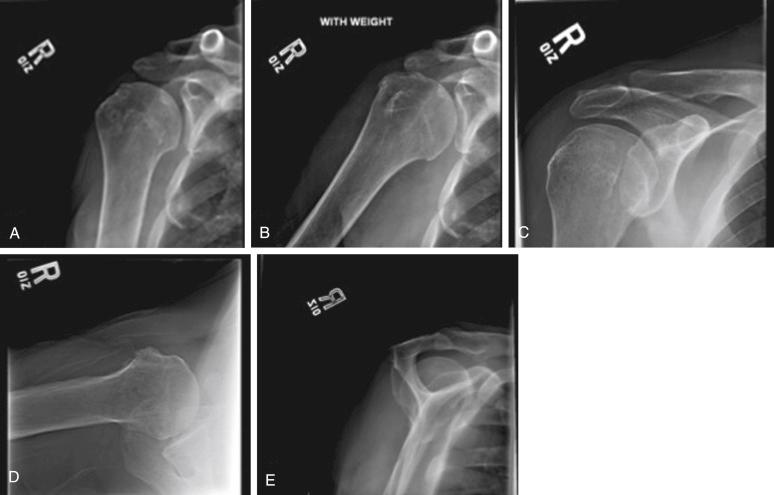 FIG. 6.1, Standard radiographic views of the shoulder obtained for a patient with suspected rotator cuff pathology, including (A) Grashey, (B) anteroposterior–weighted abduction, (C) anteroposterior shoulder, (D) axillary lateral, and (E) supraspinatus outlet views.