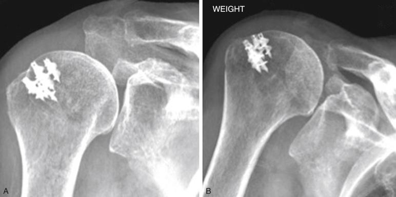 FIG. 6.2, These radiographs show superior migration of the humeral head with weighted abduction. The difference in humeral position is clear when comparing the unweighted (A) and weighted (B) images.