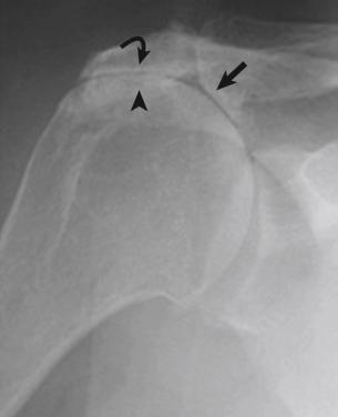 FIG. 6.3, An anteroposterior radiograph of a shoulder with chronic changes due to a massive rotator cuff tear. The acromiohumeral interval, or the distance between curved arrow and arrowhead, can be measured. The acromion has undergone acetabularization, with femoralization of the humeral head, both changes consistent with chronic massive rotator cuff tears.