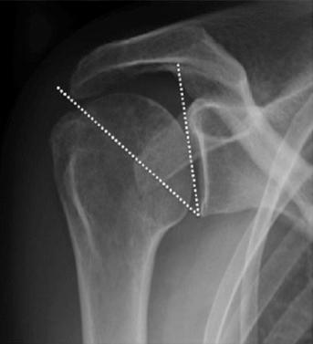 FIG. 6.4, The critical shoulder angle, measured as the angle between the glenoid inclination and the lateral aspect of the acromion, is associated with rotator cuff pathology.