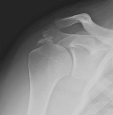 FIG. 6.5, Large calcific tendonitis lesions can have multiple calcium deposits.