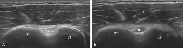 FIG. 6.7, (A) Shows the long head of the biceps (asterisk) as a hyperechoic structure when the ultrasound transducer is placed over the bicipital groove, perfectly perpendicular to the long axis of the tendon. (B) An example of the “empty groove” sign secondary to anisotropy. The transducer is placed in the wrong position, resulting in an increased number of diffracted echoes and a hypoechoic appearance. D, Deltoid; GT, greater tuberosity; LT, lesser tuberosity.