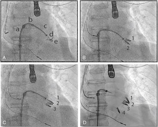 Fig. 21.2, MitraClip Fluoroscopy (Video 21.2 ).