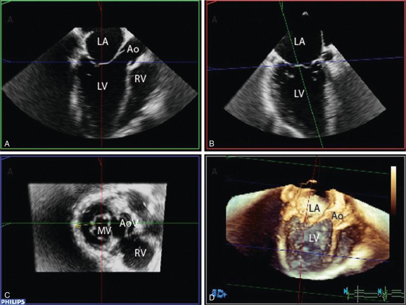 Fig. 21.3, 3D Multiplane Reconstruction of Functional Mitral Regurgitation (Video 21.3 ).