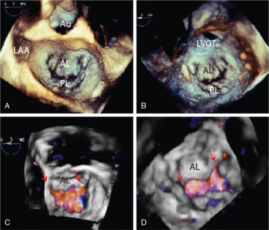 Fig. 21.4, Functional Mitral Regurgitation (MR).