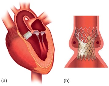 Figure 22.1, (a) Edwards Sapien® prosthesis after implantation. Courtesy of Edwards Lifesciences; (b) Medtronic CoreValve® prosthesis after implantation.